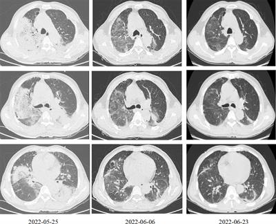 Frontiers | Case Report: Chlamydia Psittaci Pneumonia Complicated By ...